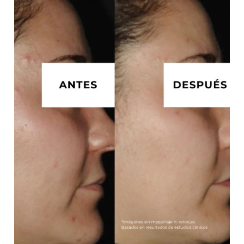 Arganour - Creme antiacne redutor de marcas  Equilibrium - Pele oleosa e com tendência acneica