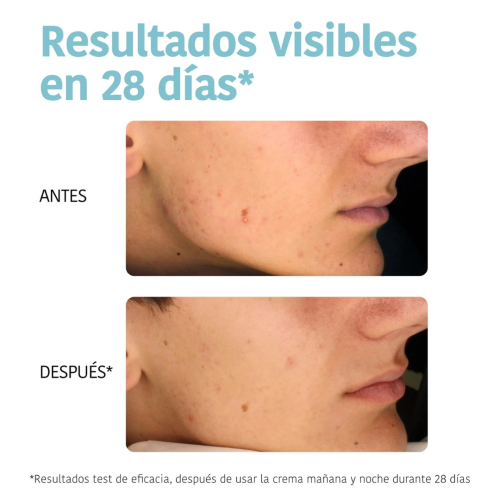 Iroha Nature - *Acne Prone Skin* - Creme facial Oil Control - Pele com tendência a acne