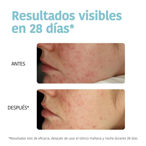 Iroha Nature - *Acne Prone Skin* - Almofadas tônicas esfoliantes - Pele com tendência a acne