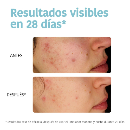 Iroha Nature - *Acne Prone Skin* - Limpador purificador - Pele com tendência a acne