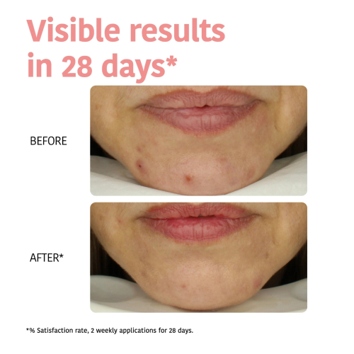 Iroha Nature - Máscara Perfect Skin Peeling - Ácido Glicólico