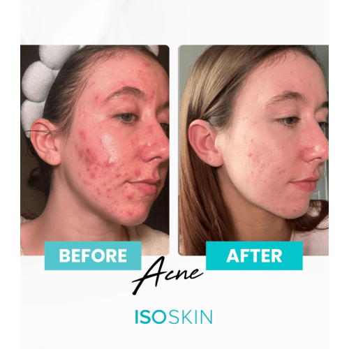 ISOCLEAN - *ISOSKIN* - Spray facial e corporal Hypochlorous - 100ml