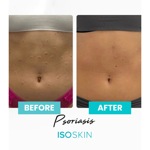 ISOCLEAN - *ISOSKIN* - Spray facial e corporal Hypochlorous - 100ml