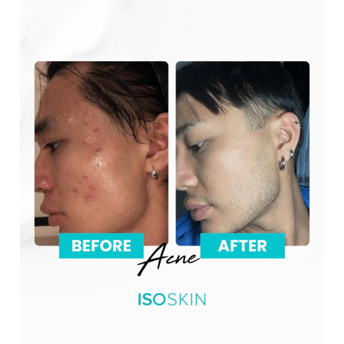 ISOCLEAN - *ISOSKIN* - Spray facial e corporal Hypochlorous - 100ml