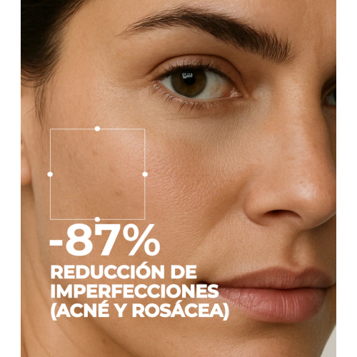 SEGLE - Kit de Tratamento Anti-Acne e Rosácea