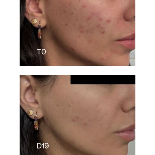 Sensilis - *Oily Skin* - Concentrado anti-imperfeições Pure 15AZ